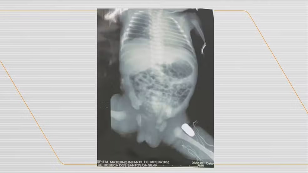  Adolescente grávida é baleada no Maranhão; raio X mostra que bala atingiu bebê